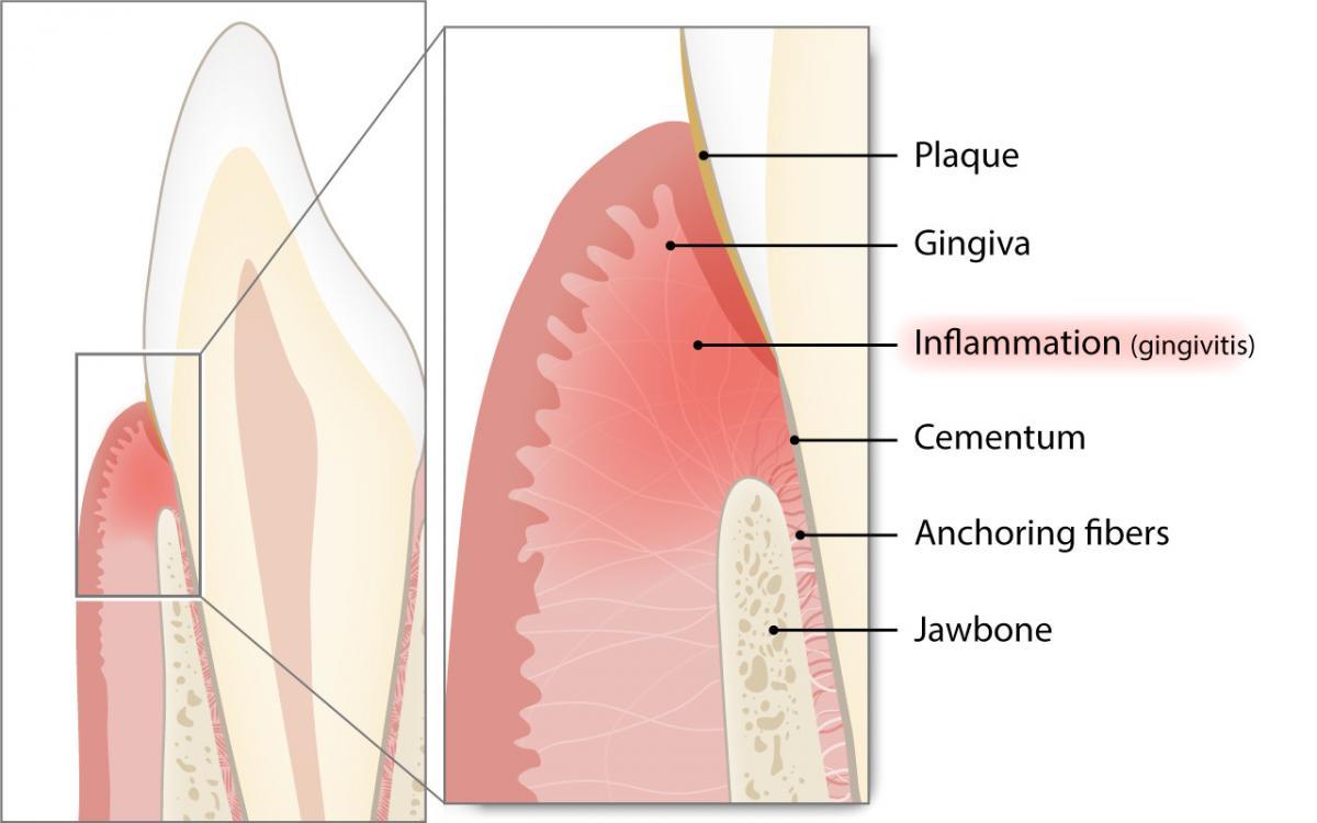 Che cos’è la gengivite e con quale frequenza si verifica?
