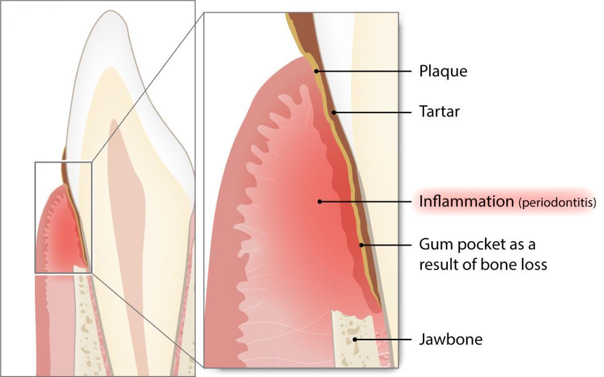 Che cos’è la parodontite e con quale frequenza si verifica?