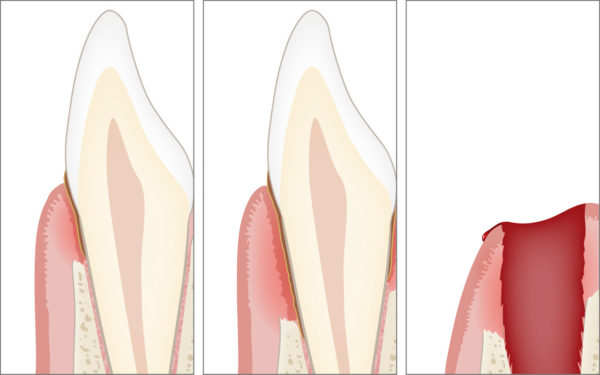 Knochenverlust und Zahnverlust als Folge sowohl der Gingivitis als auch der Parodontitis